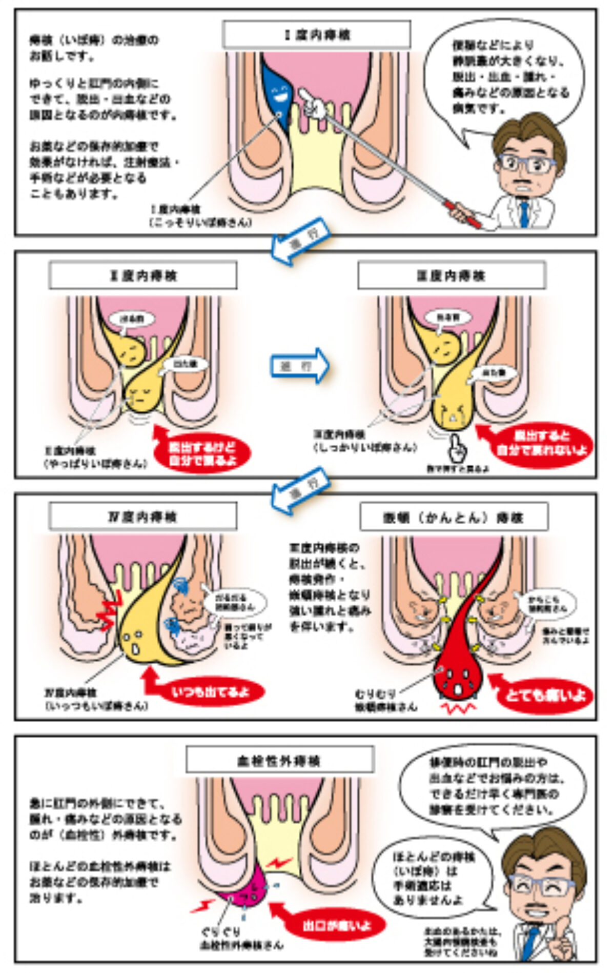 痔核（いぼ痔）編 | 神戸・元町・三ノ宮で大腸カメラ検査なら神戸元町